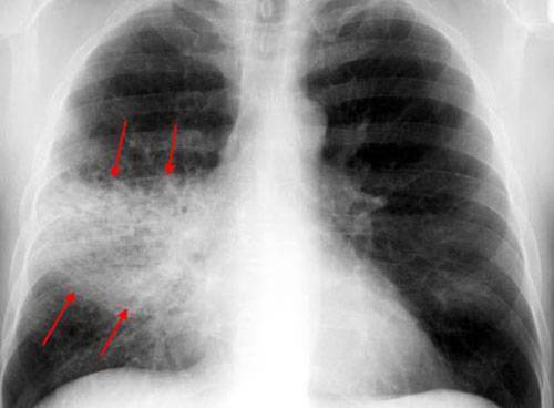 Чем бронхопневмония отличается от пневмонии?