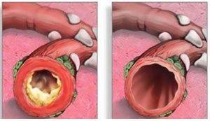 Бронхит у ребенка лечение народными средствами в домашних условиях
