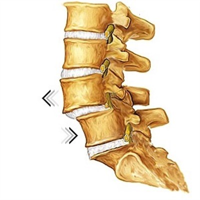 Как лечить смещение позвонков поясничного отдела