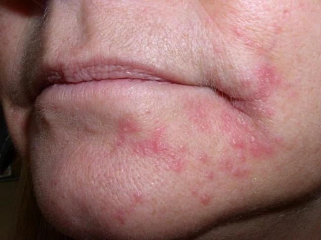 Дермовейт мазь. инструкция по применению, цена, отзывы, аналоги