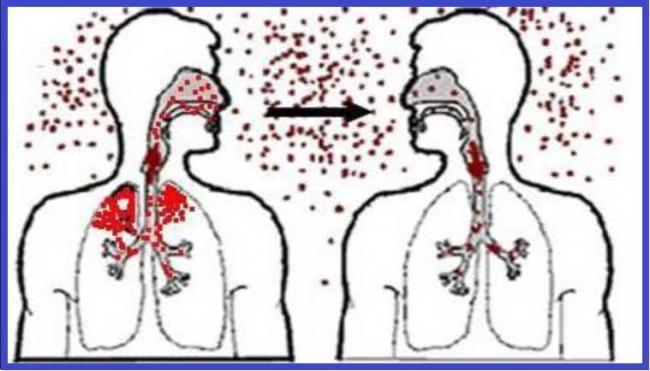 Развитие закрытой формы туберкулеза