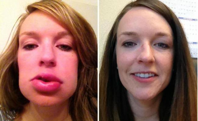 Причины, симптомы и лечение отека квинке