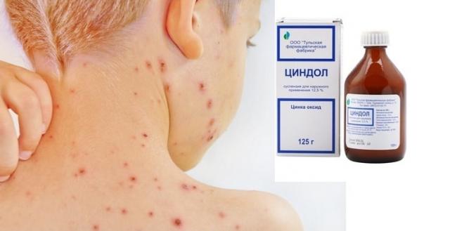 Циндол – инструкция по применению, аналоги, цена и отзывы