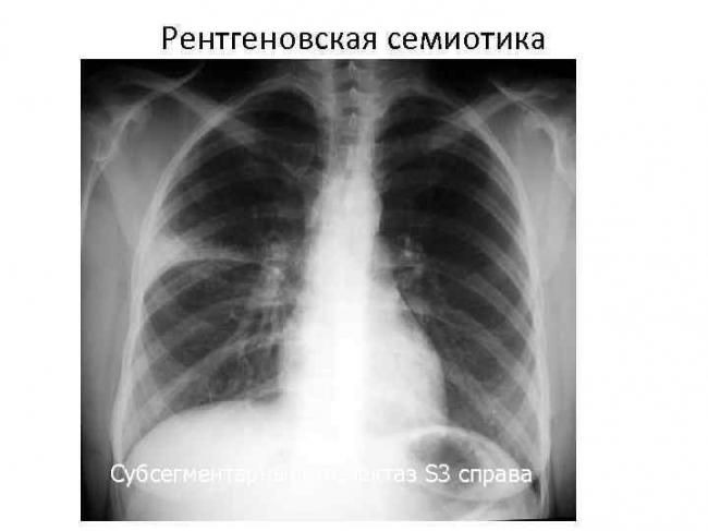 Ателектаз легкого
