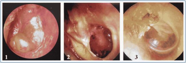 Снижение слуха и шум в ушах