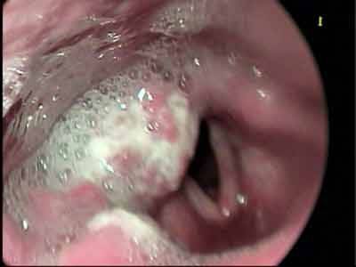 Причины и лечение слизи в носоглотке, как избавиться в домашних условиях