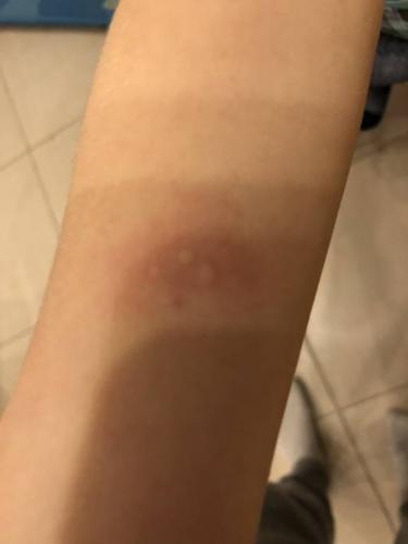 Покраснение манту: что это означает, возможные причины