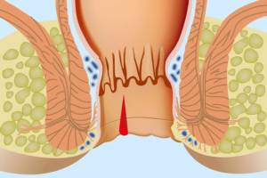 Геморрой – причины возникновения у мужчин и женщин, от чего появляется геморрой после родов?