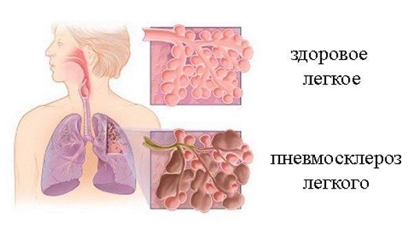 Диффузный пневмосклероз: признаки, симптомы, диагностика и лечение
