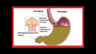 Дуодено-гастральный рефлюкс: что это?