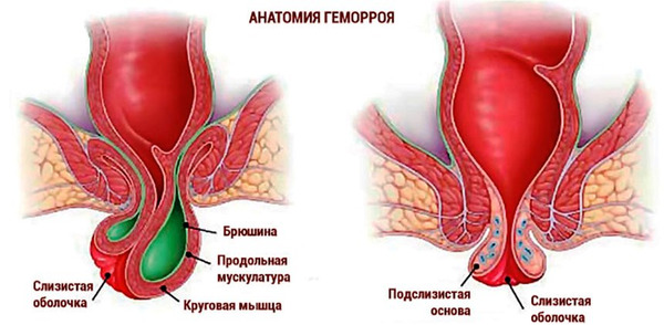 Наружный геморрой: симптомы, причины и лечение