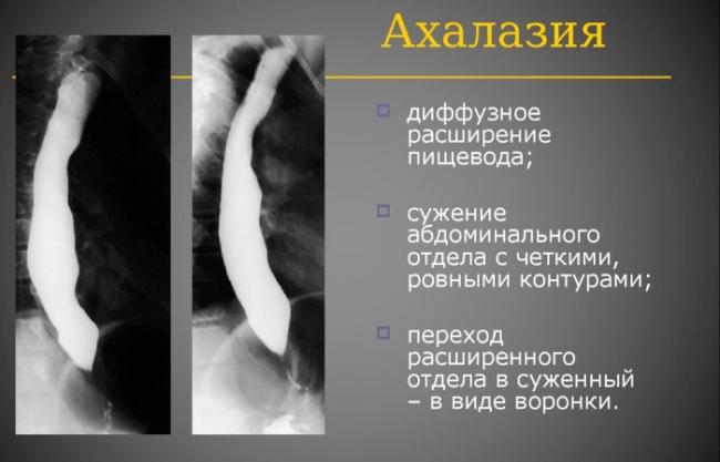 Ахалазия пищевода кардии лечение