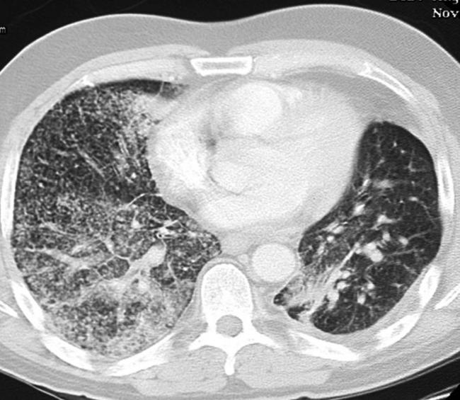 Очаг в лёгком