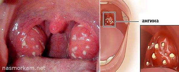 Боли в горле при глотании