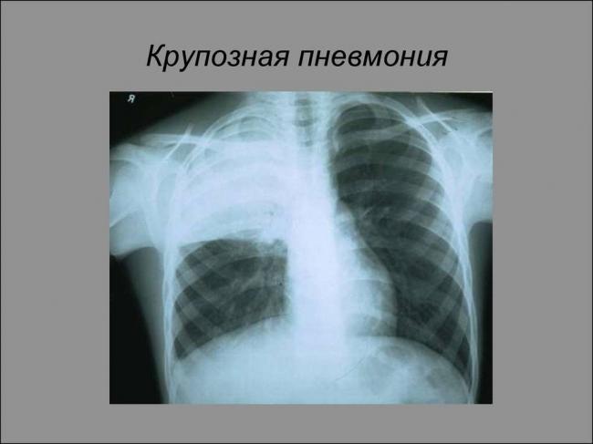 Застойная пневмония у лежачих больных: лечение, симптомы, профилактика