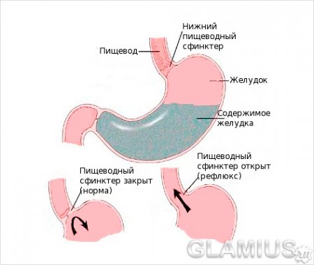 Дуоденогастральный рефлюкс: симптомы дгр, лечение