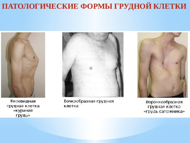 Деформация грудной клетки у ребенка: причины, лечение и разновидности