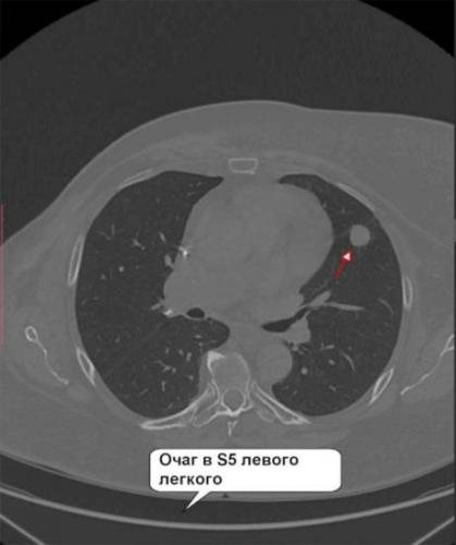 Пневмофиброз? - вопрос пульмонологу - 03 онлайн