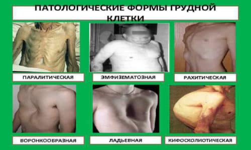 Деформация грудной клетки: степени, причины, лечение. воронкообразная и килевидная деформация грудной клетки