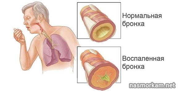 Мокрота с кровью при кашле, причины у взрослых