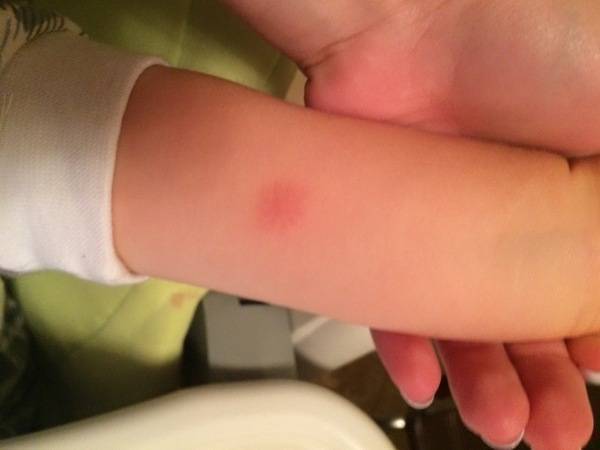 Температура после манту у детей и взрослых: причины, как избежать?