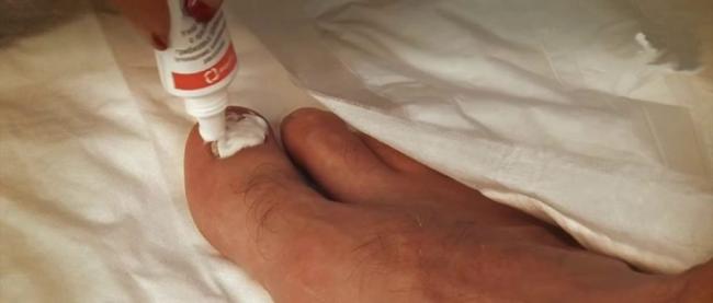 «микоспор» от грибка ногтей: отзывы, цена, инструкция