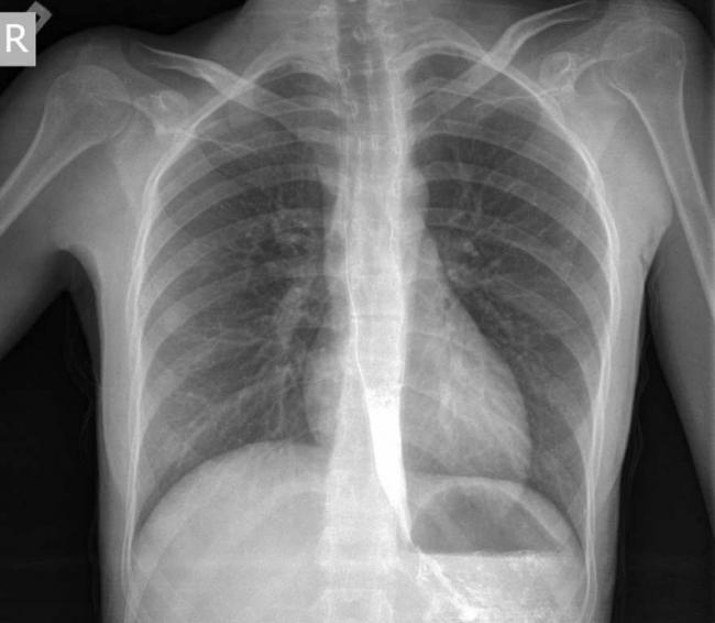 Ахалазия кардии. ахалазия пищевода: лечение современными методами и их суть. факторы и группы риска