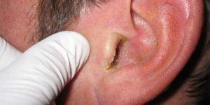 Зуд в ушах: норма и связь с болезнями, как лечить, профилактика