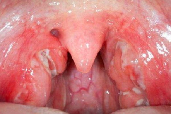 Воспаление гланд причины симптомы лечение