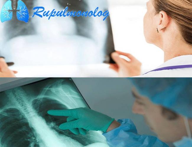 Пневмония. схема лечения у взрослого, антибиотики, народные средства, лекарства