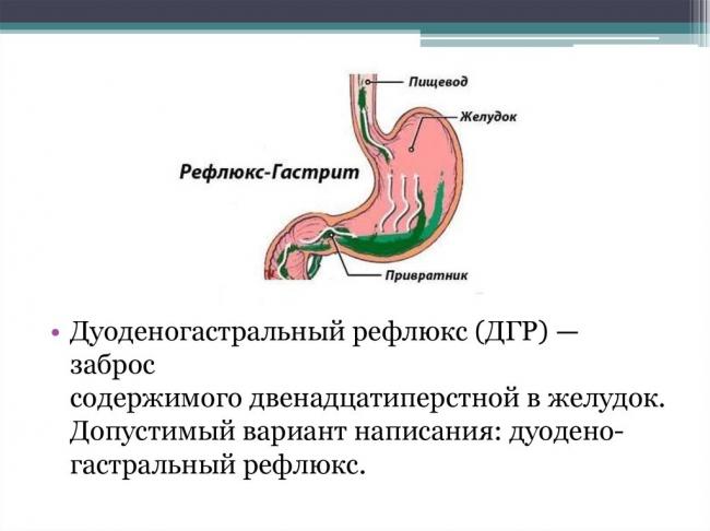 Дуодено гастральный рефлюкс у ребенка. как лечить дуодено гастральный желчный рефлюкс