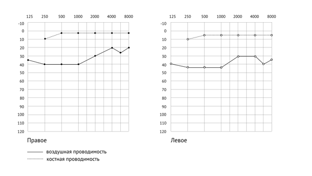 Кохлеарный неврит