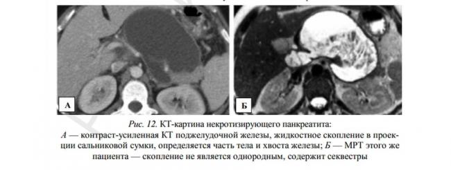 Диета стол 5 меню на каждый день рецепты при панкреатите
