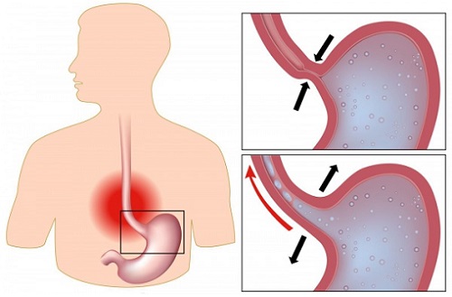 Диета при эзофагите