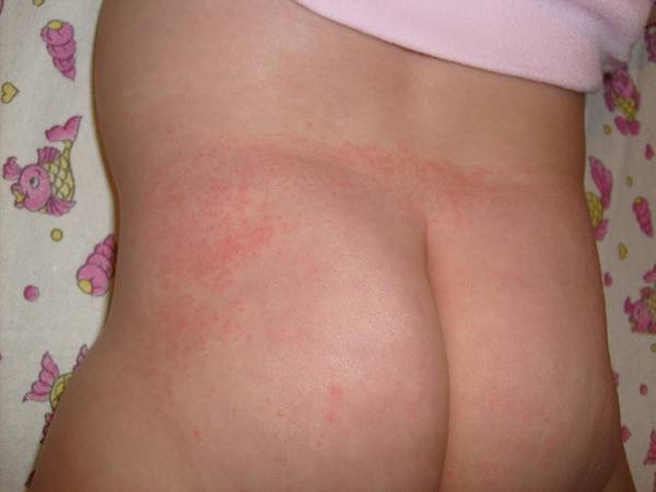 Красная попа вокруг ануса у новорожденного и грудничка