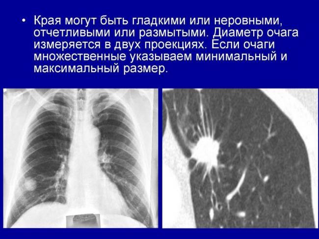 Почему возникают и чем опасны очаги в легких