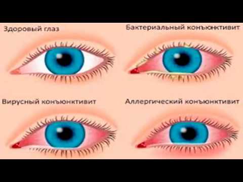 Лечение конъюнктивита