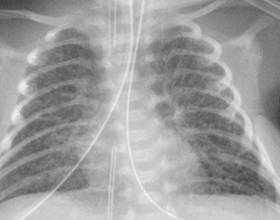 Причины, лечение и последствия пневмонии у новорожденных