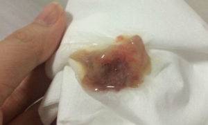 Мокрота с кровью при кашле по утрам