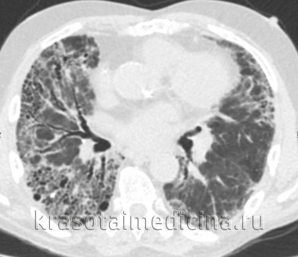 Пневмосклероз. причины, симптомы, признаки, диагностика и лечение патологии :: polismed.com
