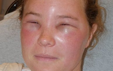 Причины, симптомы и лечение отека квинке