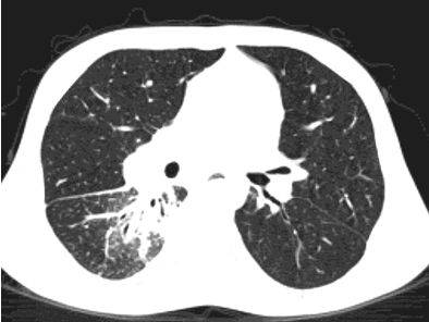 Расшифровка кт органов грудной клетки