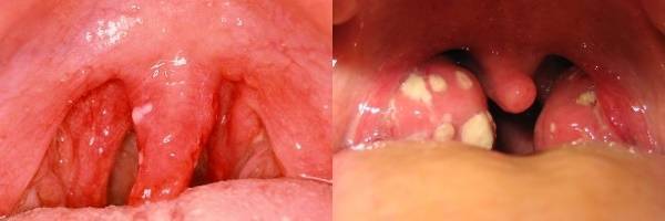 Болит горло слева глотать не больно | советы доктора