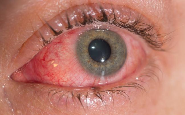 Обзор 15 лучших капель от конъюнктивита для детей