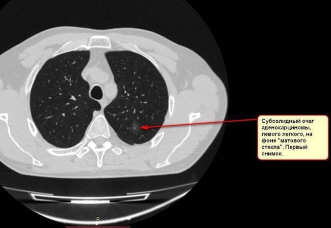 Расшифровка кт органов грудной клетки