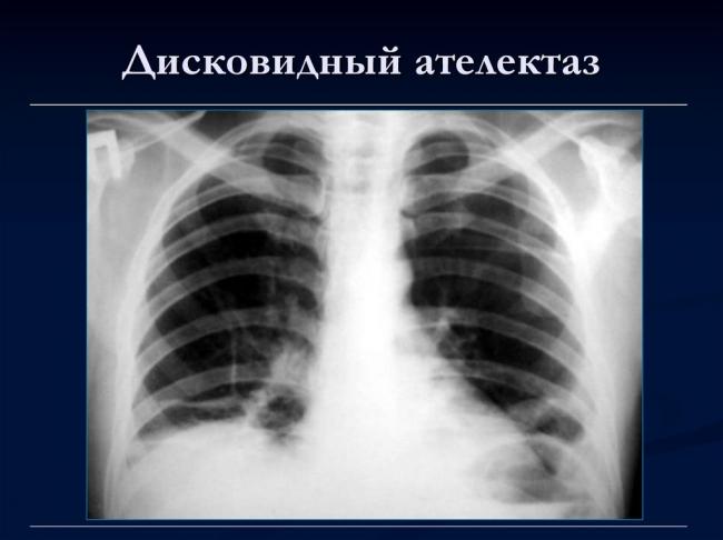 Ателектаз легкого: развитие, причины, симптоматика, диагностика, лечение