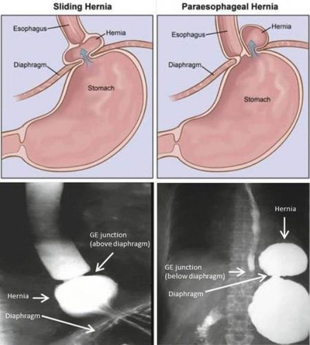 Недостаточность кардии желудка лечение народными средствами