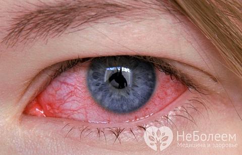 Возвращаем глазам нормальный вид: методы лечения конъюнктивита у детей и перечень препаратов