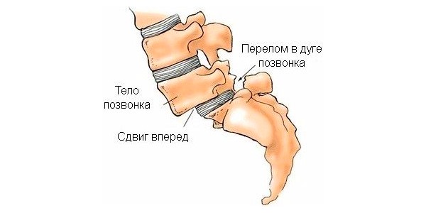 Спондилолистз смещение позвонков пояснично-крестцового отдела позвоночника симптомы