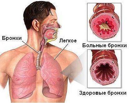 Белая мокрота